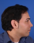 After Hair Transplant&nbsp;Front